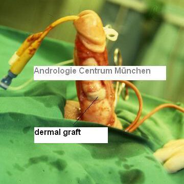 andrologie-centrum-muenchen-refertilisierung-dermal-graft61